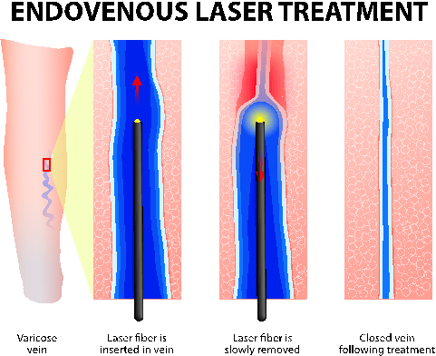 Laser Therapy