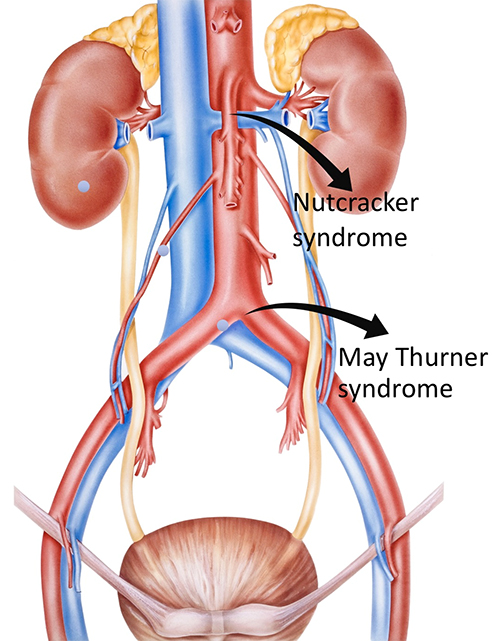 Venous Compression