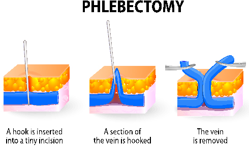 Vein Removal Surgery