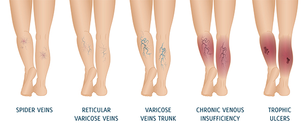  Varicose Veins