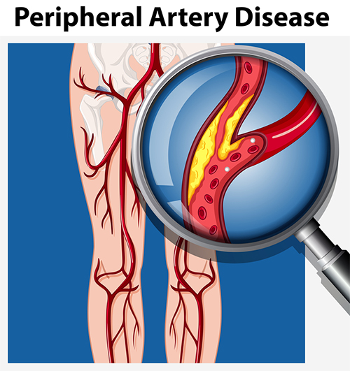  Varicose Veins