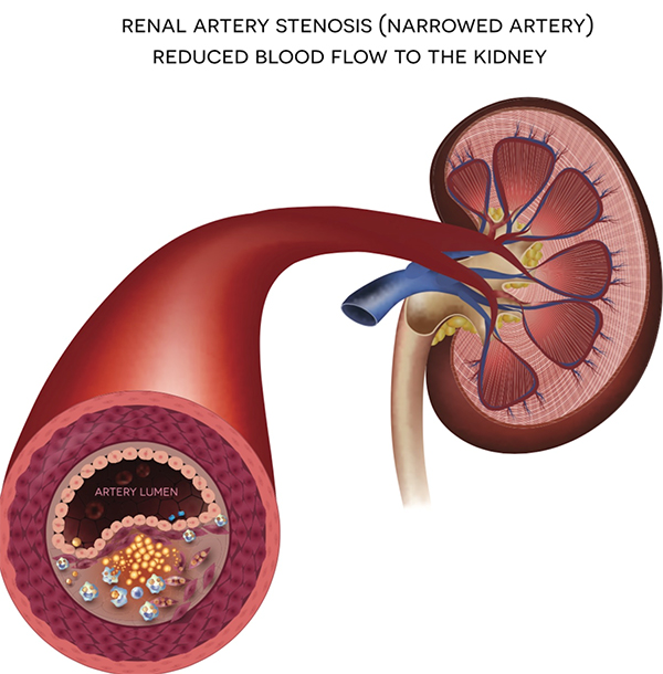 Renovascular Disease