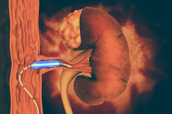 Angioplasty and Stenting