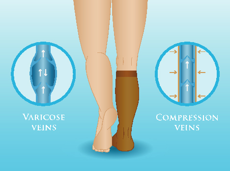 Compression Stockings