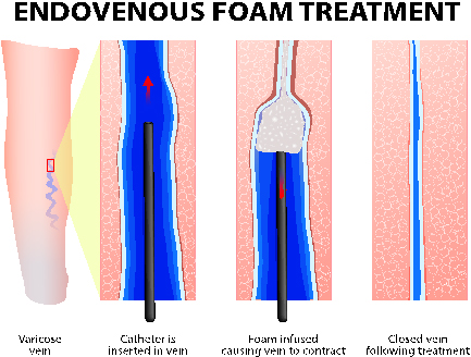 Sclerotherapy