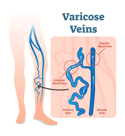  Varicose Veins