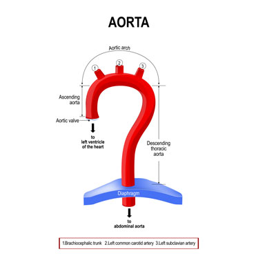  Aortic Dissection