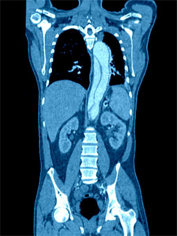 Aortic Dissection