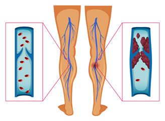  Varicose Veins