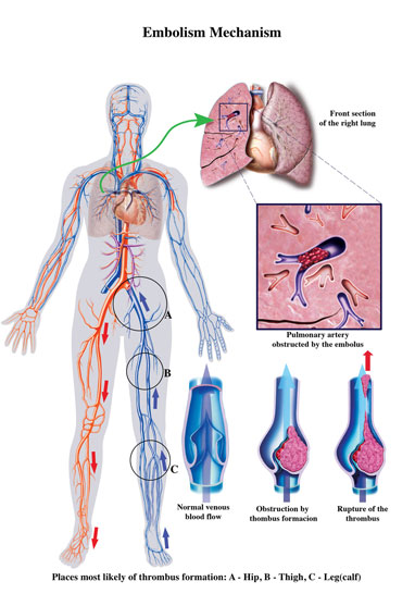  Varicose Veins